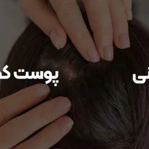 آبرسانی پوست کف سر